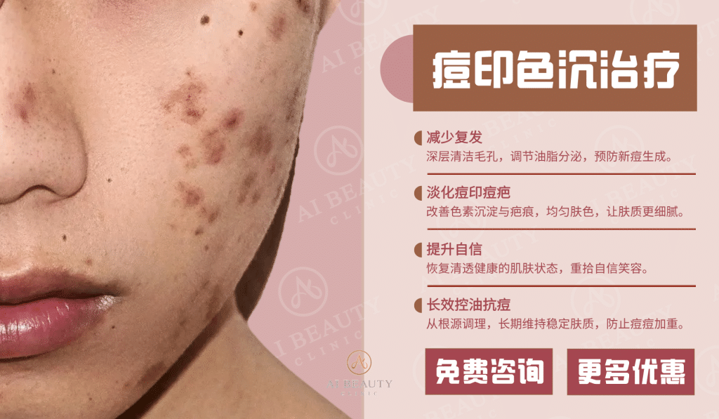 痘印色沉ci