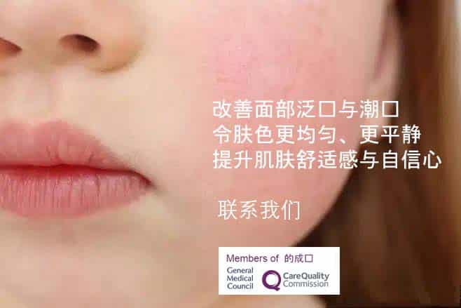 face redness