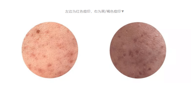 痘印色沉