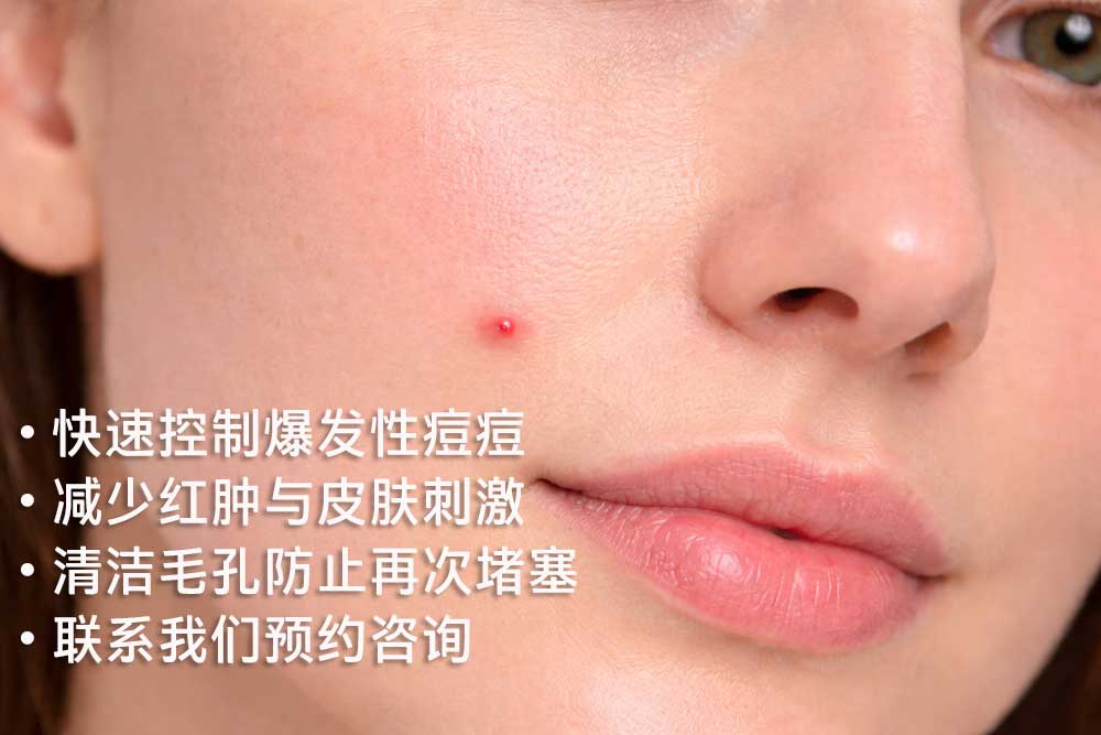 pimple中文